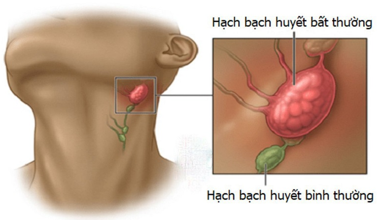 Ung thư hạch bạch huyết sống được bao lâu? 1