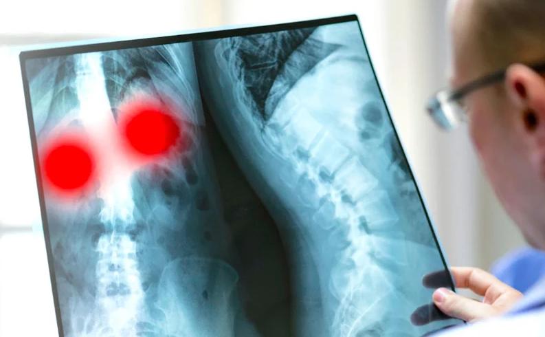 Ung thư phổi có ăn được sâm không? Lưu ý quan trọng khi sử dụng nhân sâm 3