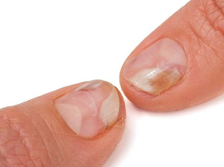 Vảy nến móng tay: Nguyên nhân, triệu chứng và cách điều trị 1