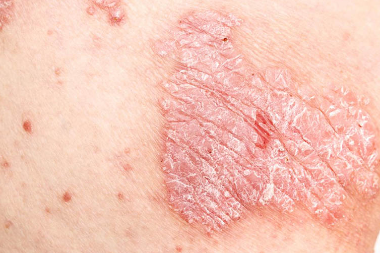 bai-viet/vay-nen-vung-kin-la-gi-cach-dieu-tri-benh-nhu-the-nao.html 1