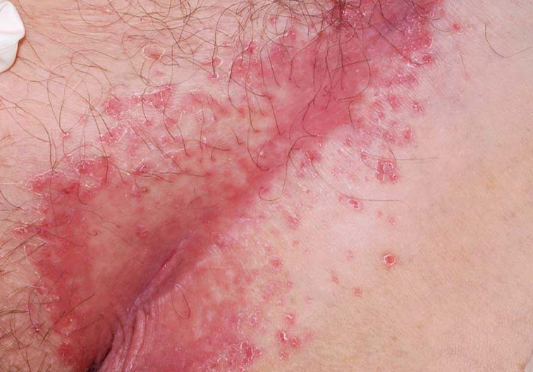 bai-viet/vay-nen-vung-kin-la-gi-cach-dieu-tri-benh-nhu-the-nao.html 2