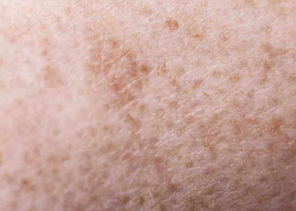 Vì sao có hiện tượng tăng sắc tố da sau laser? 2