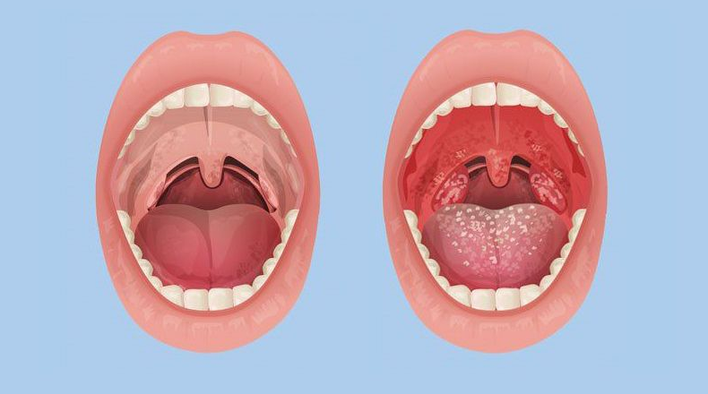 Viêm amidan có lây không và cách phòng ngừa bệnh thế nào? 1