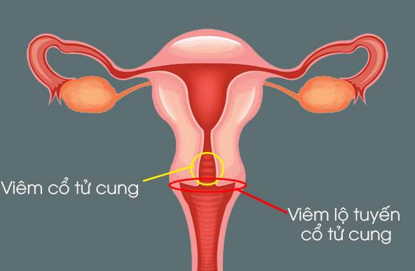 Viêm cổ tử cung và viêm lộ tuyến cổ tử cung có giống nhau không? 1