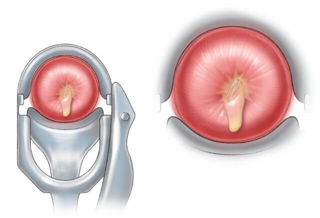 Viêm cổ tử cung và viêm lộ tuyến cổ tử cung có giống nhau không? 2