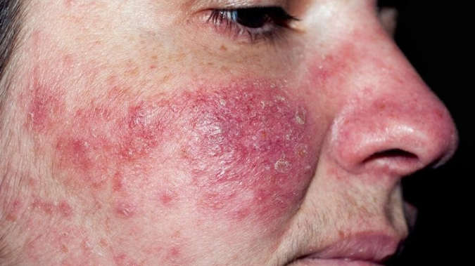 Viêm da do Demodex có triệu chứng gì? Cách điều trị và phòng bệnh 3