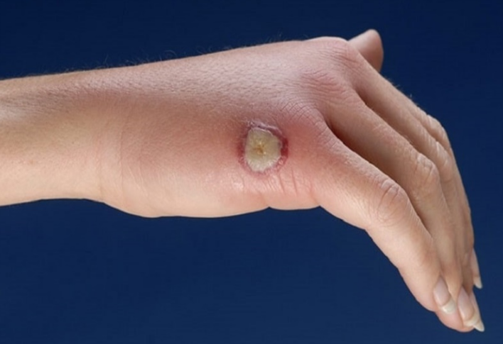 Viêm da mủ hoại thư là bệnh gì? Có nguy hiểm không? 1