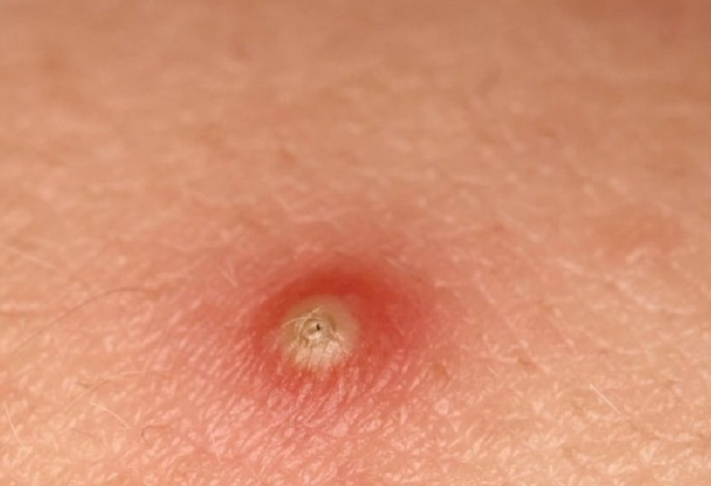 Viêm da mủ hoại thư là bệnh gì? Có nguy hiểm không? 3