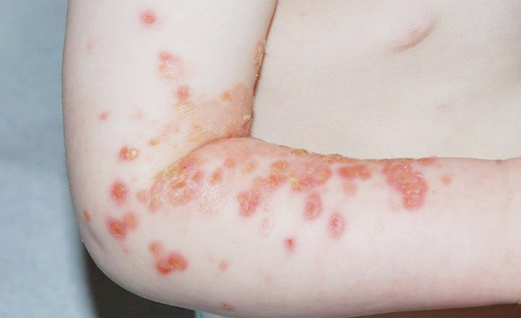 Viêm da mủ: Nguyên nhân gây bệnh và lưu ý khi điều trị 4