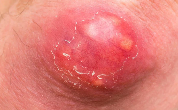 Viêm da mủ: Nguyên nhân gây bệnh và lưu ý khi điều trị 3