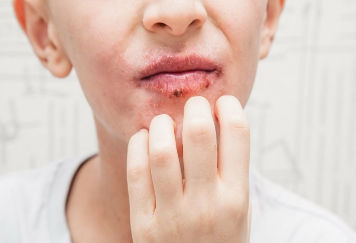Viêm da quanh miệng là bệnh gì? Có nguy hiểm không? 2