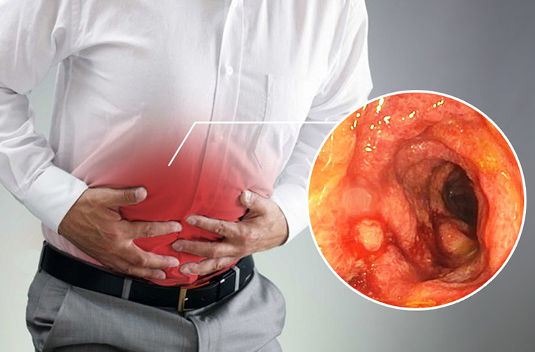 Viêm đại tràng nên ăn quả gì để cải thiện triệu chứng bệnh? 1