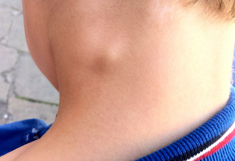 Viêm hạch bạch huyết cấp tính có nguy hiểm không? 1