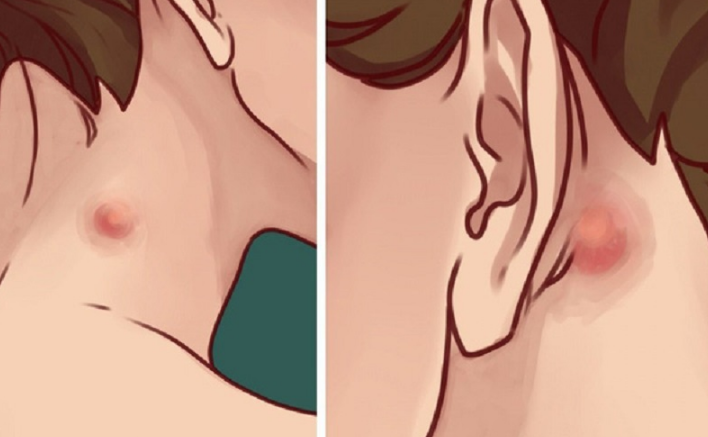 Viêm hạch bạch huyết ở trẻ em là bệnh gì? 1