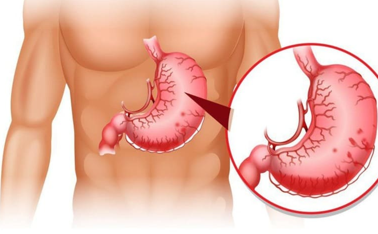 Viêm phù nề xung huyết trợt rải rác hang vị là bệnh gì? 1