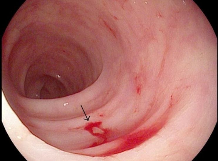 Viêm phù nề xung huyết trợt rải rác hang vị là bệnh gì? 2