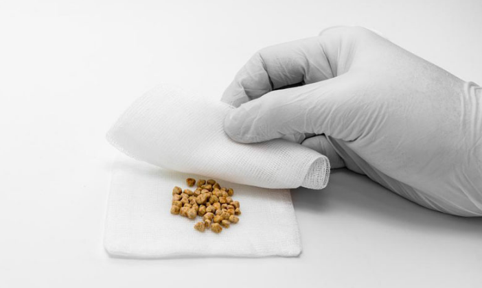 Viêm túi mật do sỏi: Căn bệnh nguy hiểm, có thể gây tử vong 1