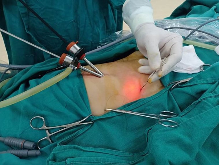 Viêm túi mật do sỏi: Căn bệnh nguy hiểm, có thể gây tử vong 3