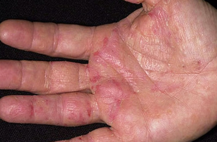 Xét nghiệm 60 dị nguyên là gì? Quy trình thực hiện như thế nào? 2