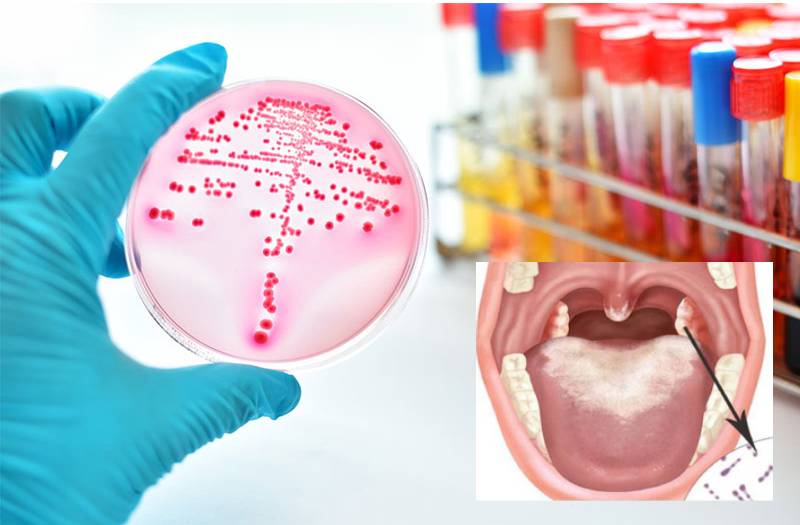 Xét nghiệm bạch hầu để làm gì? Khi nào nên xét nghiệm? 1