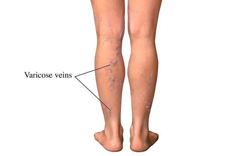 Bấm huyệt chữa suy giãn tĩnh mạch 1