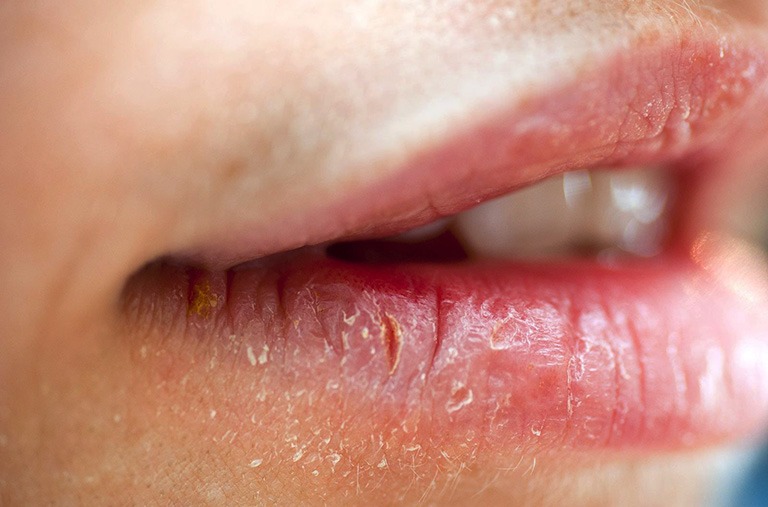 Bạn biết gì về bệnh viêm môi do nấm? 1