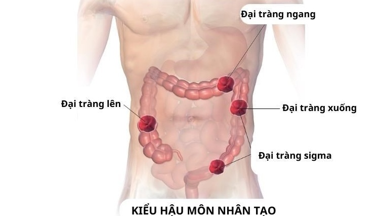 Bạn biết gì về hậu môn nhân tạo? 2
