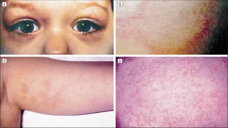 Bạn biết gì về hội chứng chu kỳ liên quan đến thụ thể TNF? 1