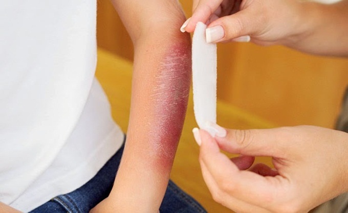 Bạn đã biết cách sơ cứu bỏng cồn hay chưa? 3