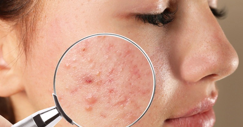 Bạn đã biết công dụng của Vitamin A trong việc giảm nếp nhăn và ngăn ngừa mụn chưa? 3