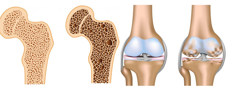 Bạn đã biết phân biệt loãng xương và thoái hóa khớp chưa? 1