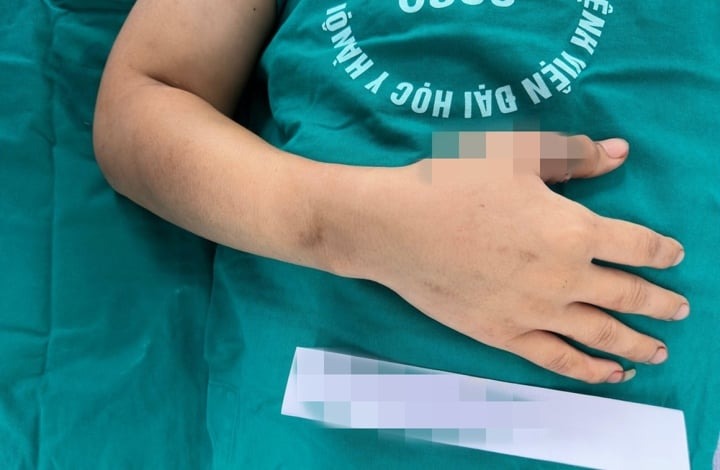 Cách sơ cứu và bảo quản chi thể đứt rời 1