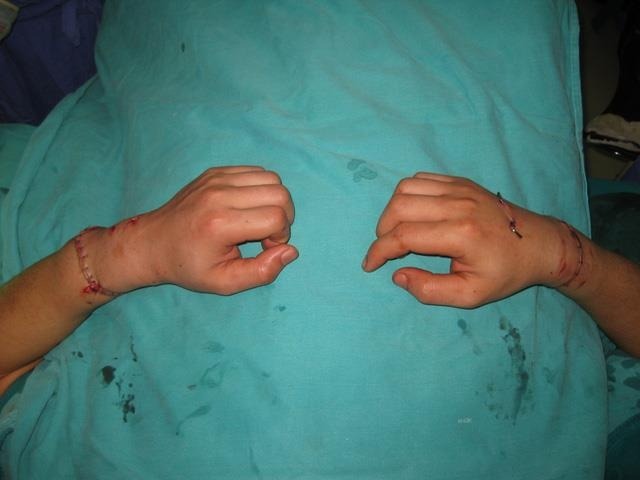 Cách sơ cứu và bảo quản chi thể đứt rời 2