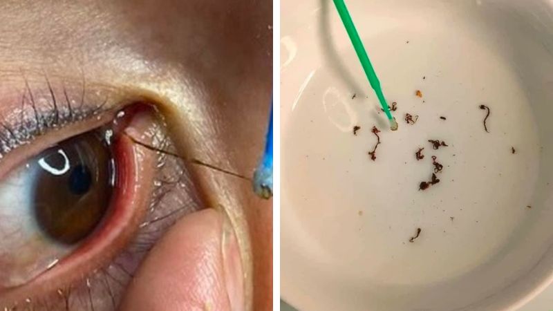 Bắt sâu mắt lợi hay hại? Đọc ngay chia sẻ của các chuyên gia 2