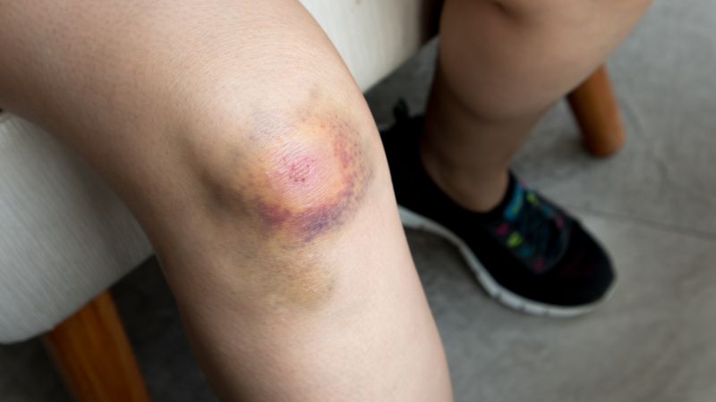 Bé hay bị vết bầm tím ở chân: Nguyên nhân và cách xử trí phù hợp 1