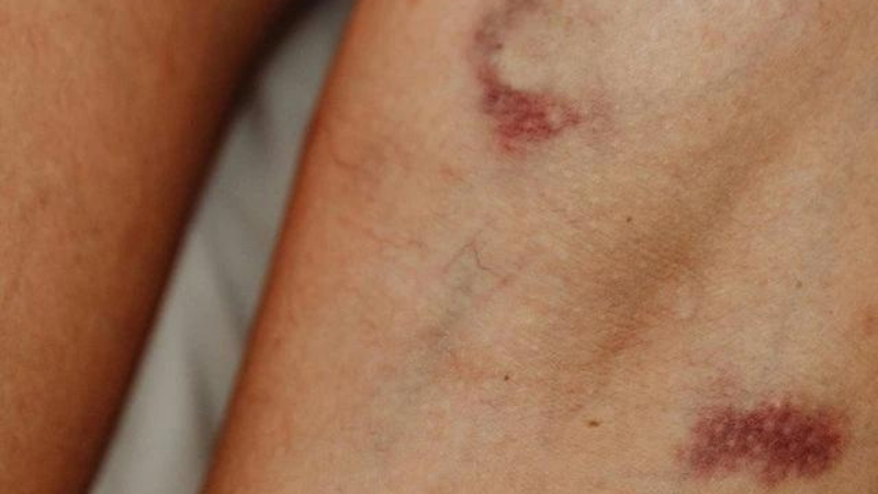 Bé hay bị vết bầm tím ở chân: Nguyên nhân và cách xử trí phù hợp 4