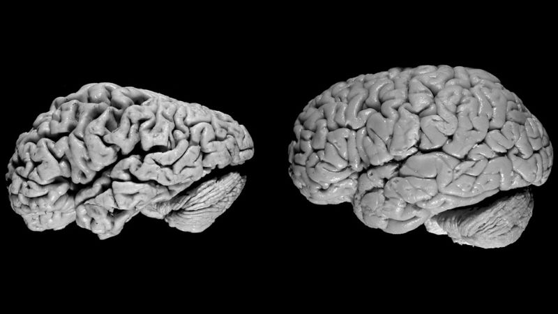 Bệnh Alzheimer được chẩn đoán thế nào? 1