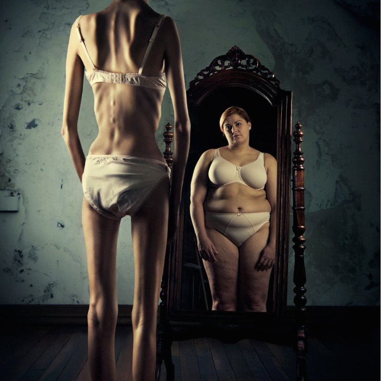 Bệnh Anorexia là gì? 2