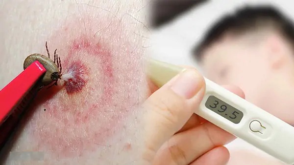 Bệnh Babesiosis (Babesia): Nguyên nhân, triệu chứng, chữa trị và cách phòng ngừa 1