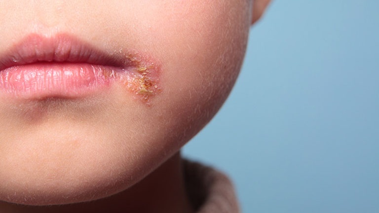 Bệnh chốc lở bao lâu thì khỏi? Cần lưu ý gì trong quá trình điều trị bệnh 3