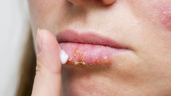 Bệnh chốc lở bao lâu thì khỏi? Cần lưu ý gì trong quá trình điều trị bệnh 7