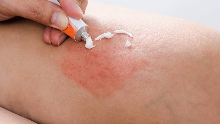 Bệnh chốc lở dùng thuốc gì? Những lưu ý khi điều trị bệnh chốc lở 7