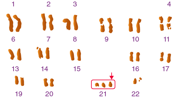 Bộ nhiễm sắc thể của người mắc hội chứng Down 1