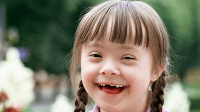 Trẻ mắc hội chứng Down 2