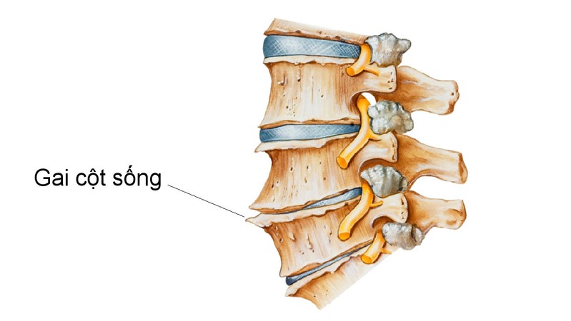 Bệnh gai cột sống là gì? Bị gai cột sống có chữa được không? 6