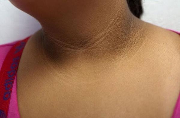 Bệnh gai đen ở cổ: Nguyên nhân, triệu chứng và phương pháp điều trị3