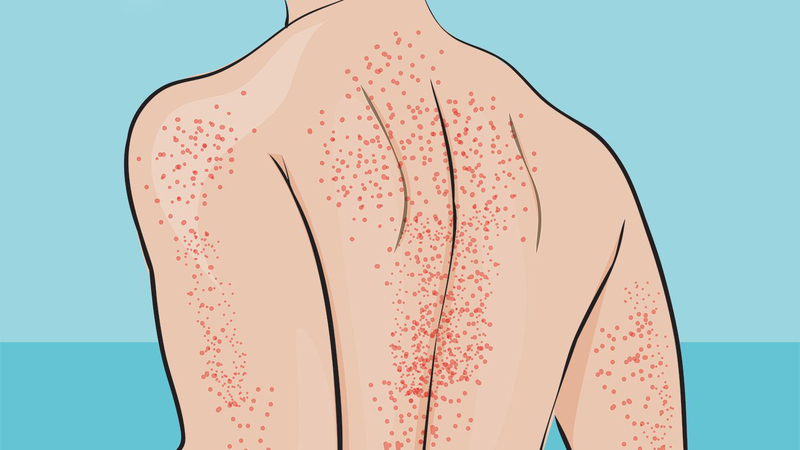 benh-giam-tieu-cau-co-chua-duoc-khong-nhung-dieu-can-biet 4