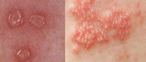 Bệnh giời leo có để lại sẹo không? Cách phòng ngừa và điều trị hiệu quả 2