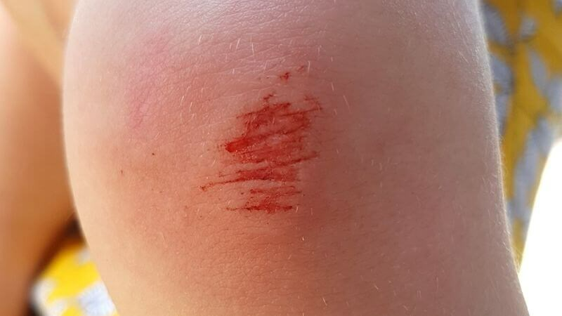 Bệnh HIV có lây qua vết xước nhỏ hay không?3