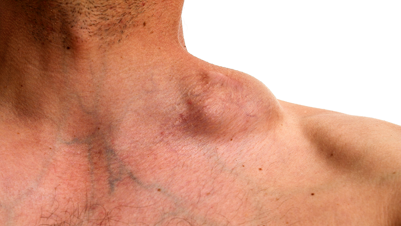 Bệnh Hodgkin và những thông tin quan trọng nhất 1